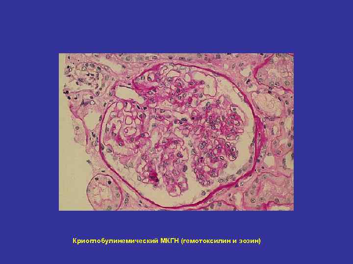 Криоглобулинемический МКГН (гемотоксилин и эозин) 