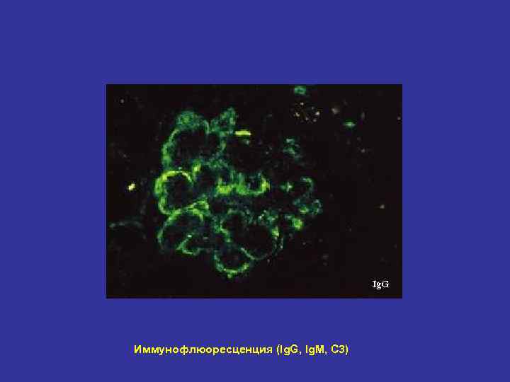 Ig. G Иммунофлюоресценция (Ig. G, Ig. M, C 3) 