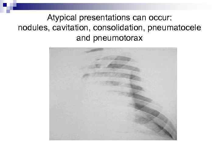 Аtypical presentations can occur: nodules, cavitation, consolidation, pneumatocele and pneumotorax 