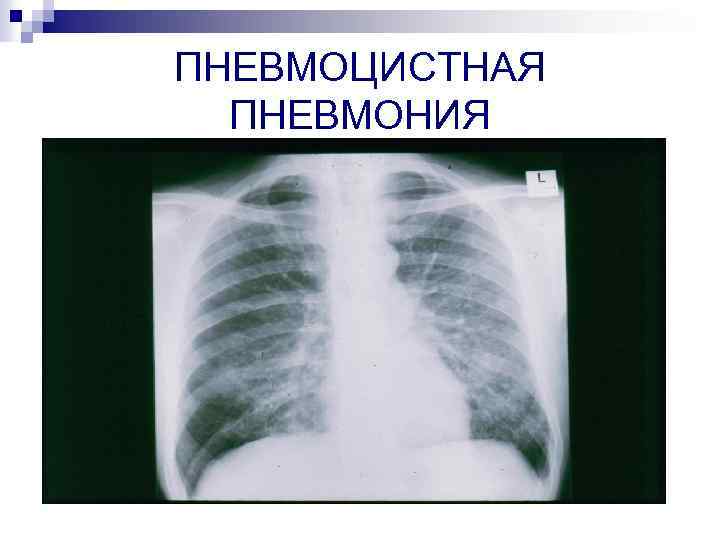 ПНЕВМОЦИСТНАЯ ПНЕВМОНИЯ 