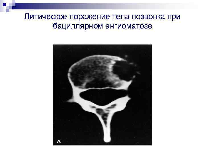 Литическое поражение тела позвонка при бациллярном ангиоматозе 