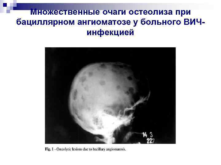 Множественные очаги остеолиза при бациллярном ангиоматозе у больного ВИЧинфекцией 