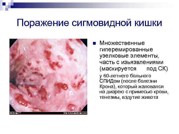 Поражение сигмовидной кишки n Множественные гиперемированные узелковые элементы, часть с изьязвлениями (маскируется под СК)