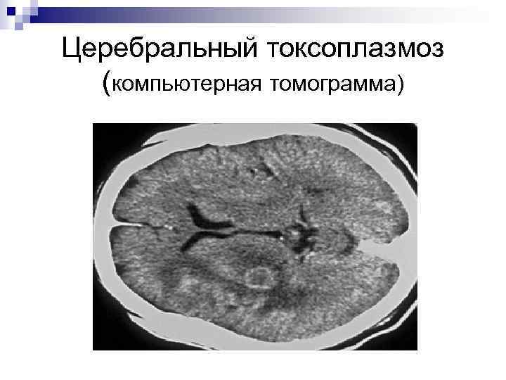 Церебральный токсоплазмоз (компьютерная томограмма) 