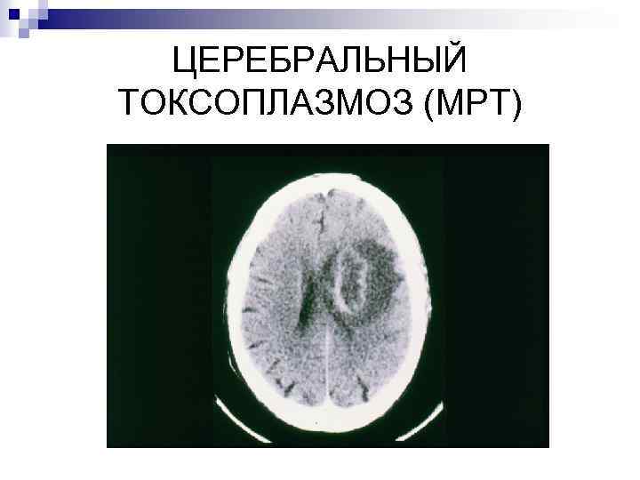 ЦЕРЕБРАЛЬНЫЙ ТОКСОПЛАЗМОЗ (МРТ) 