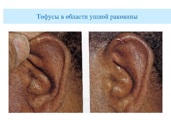 Тофусы в области ушной раковины 