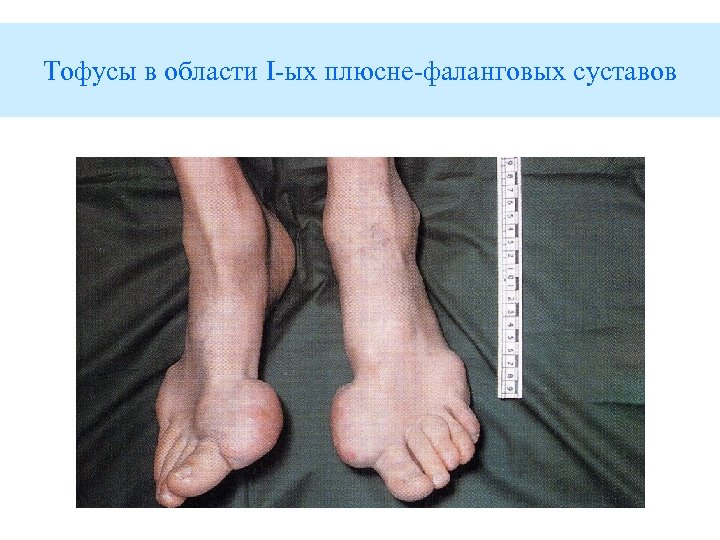 Тофусы в области I-ых плюсне-фаланговых суставов 