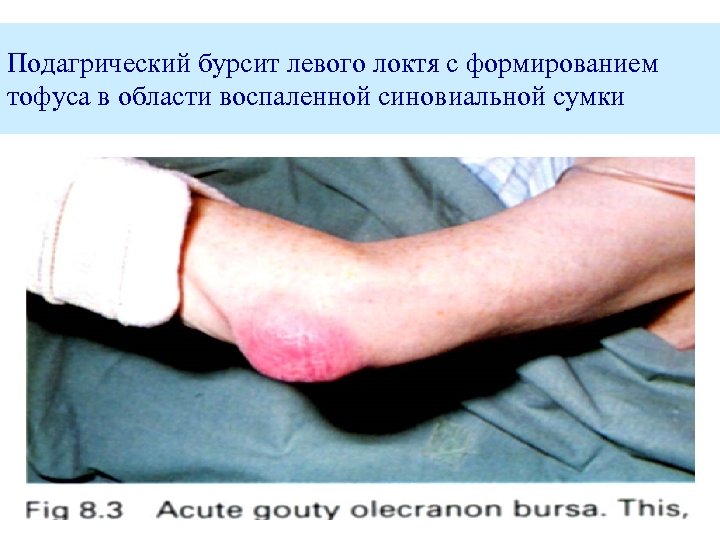 Подагрический бурсит левого локтя с формированием тофуса в области воспаленной синовиальной сумки 