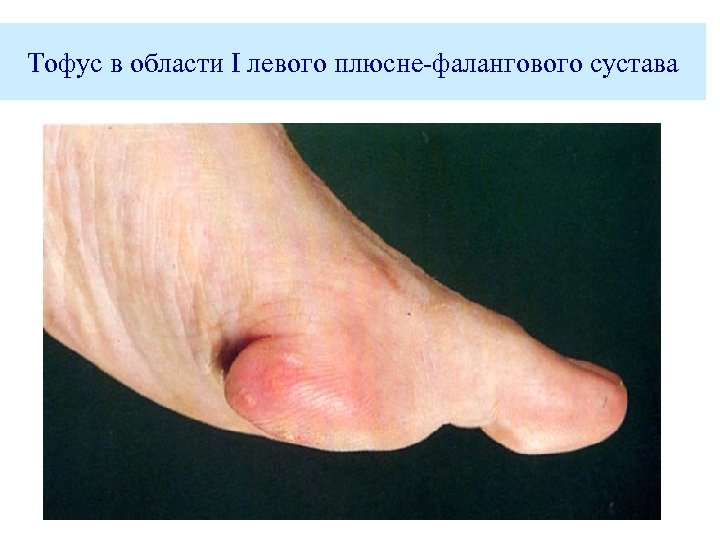 Тофус в области I левого плюсне-фалангового сустава 