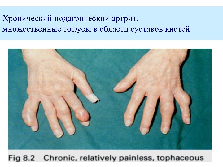 Хронический подагрический артрит, множественные тофусы в области суставов кистей 