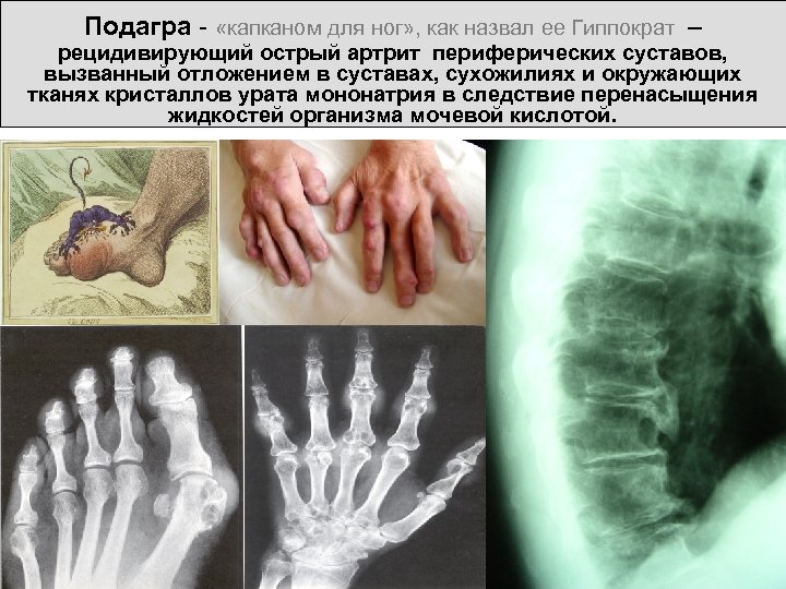 Подагра - «капканом для ног» , как назвал ее Гиппократ – рецидивирующий острый артрит