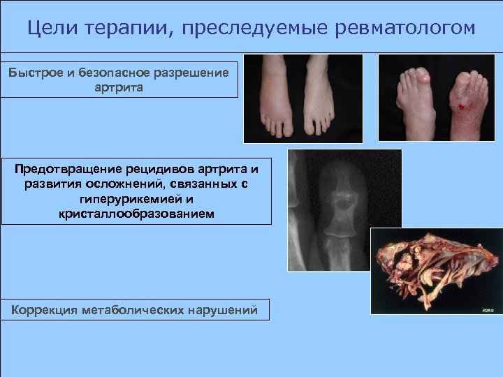 Цели терапии, преследуемые ревматологом Быстрое и безопасное разрешение артрита Предотвращение рецидивов артрита и развития