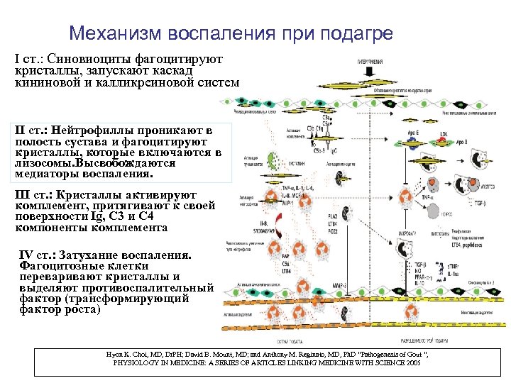 Механизм воспаления при подагре I ст. : Синовиоциты фагоцитируют кристаллы, запускают каскад кининовой и