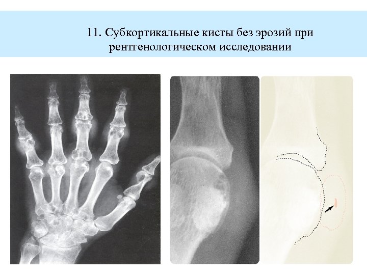 11. Субкортикальные кисты без эрозий при рентгенологическом исследовании 