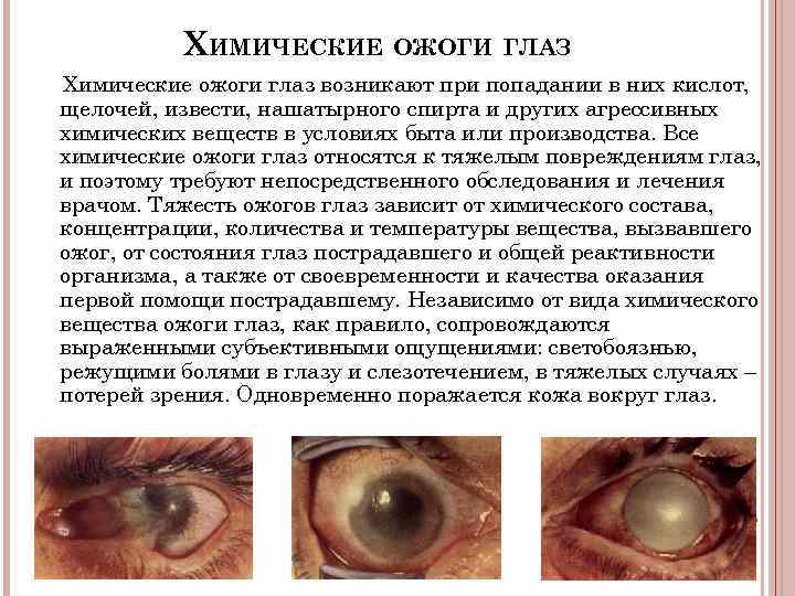 ХИМИЧЕСКИЕ ОЖОГИ ГЛАЗ Химические ожоги глаз возникают при попадании в них кислот, щелочей, извести,