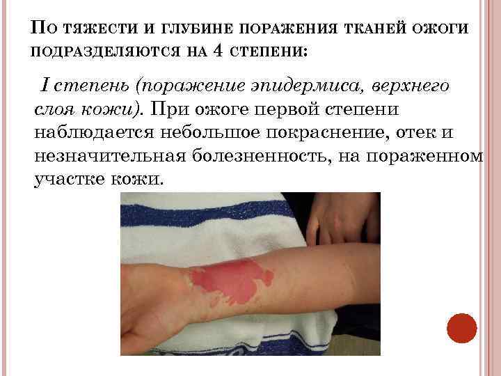 ПО ТЯЖЕСТИ И ГЛУБИНЕ ПОРАЖЕНИЯ ТКАНЕЙ ОЖОГИ ПОДРАЗДЕЛЯЮТСЯ НА 4 СТЕПЕНИ: I степень (поражение
