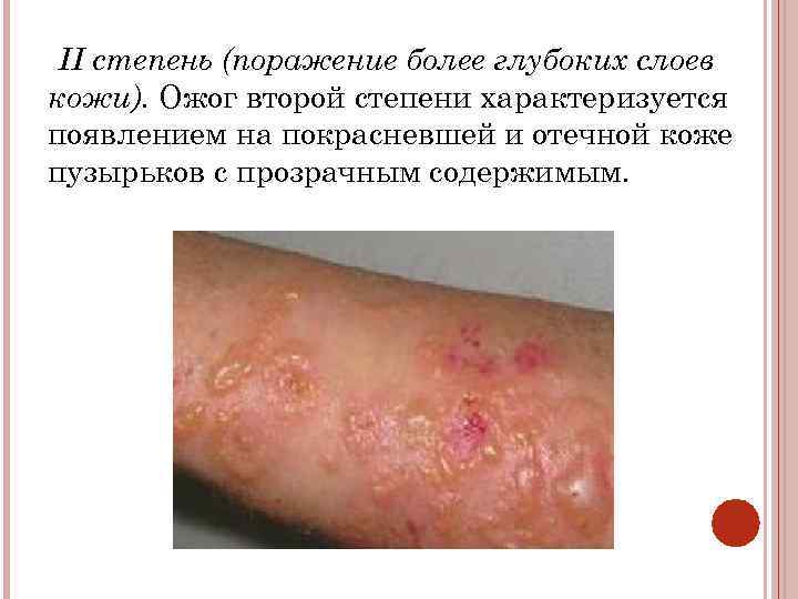 II степень (поражение более глубоких слоев кожи). Ожог второй степени характеризуется появлением на покрасневшей