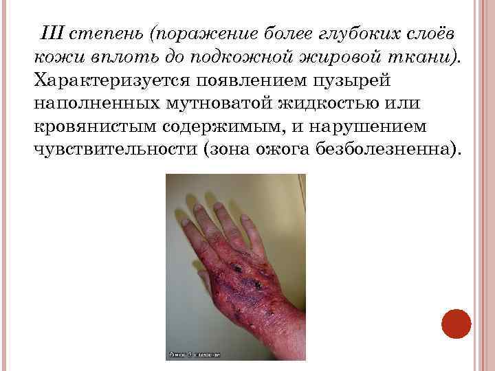 III степень (поражение более глубоких слоёв кожи вплоть до подкожной жировой ткани). Характеризуется появлением