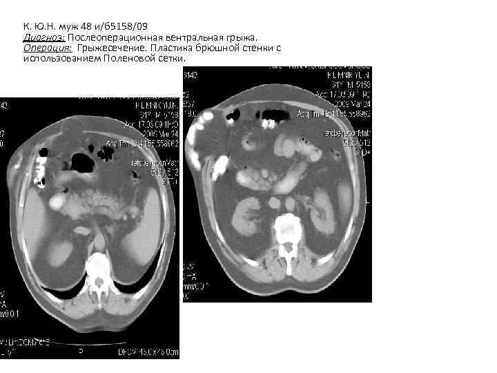 К. Ю. Н. муж 48 и/б 5158/09 Диагноз: Послеоперационная вентральная грыжа. Операция: Грыжесечение. Пластика