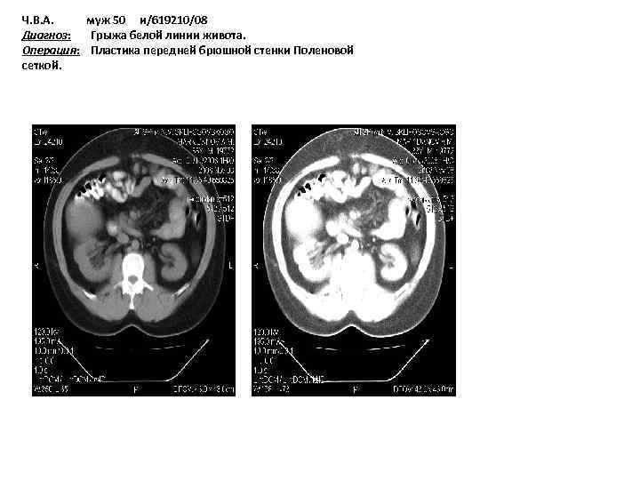 Ч. В. А. муж 50 и/619210/08 Диагноз: Грыжа белой линии живота. Операция: Пластика передней