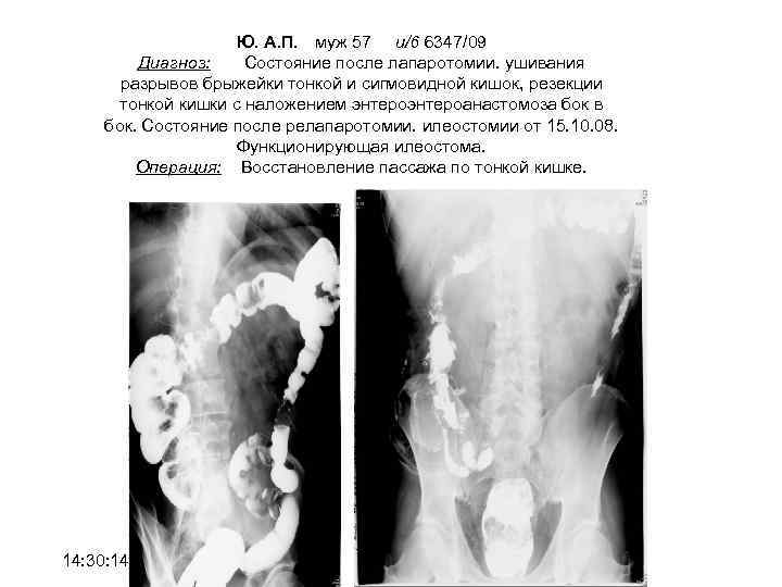 Ю. А. П. муж 57 и/6 6347/09 Диагноз: Состояние после лапаротомии. ушивания разрывов брыжейки