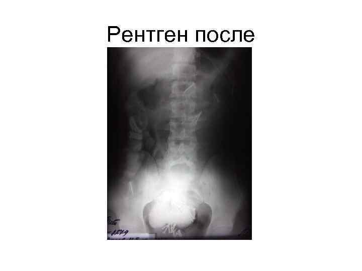Рентген после 