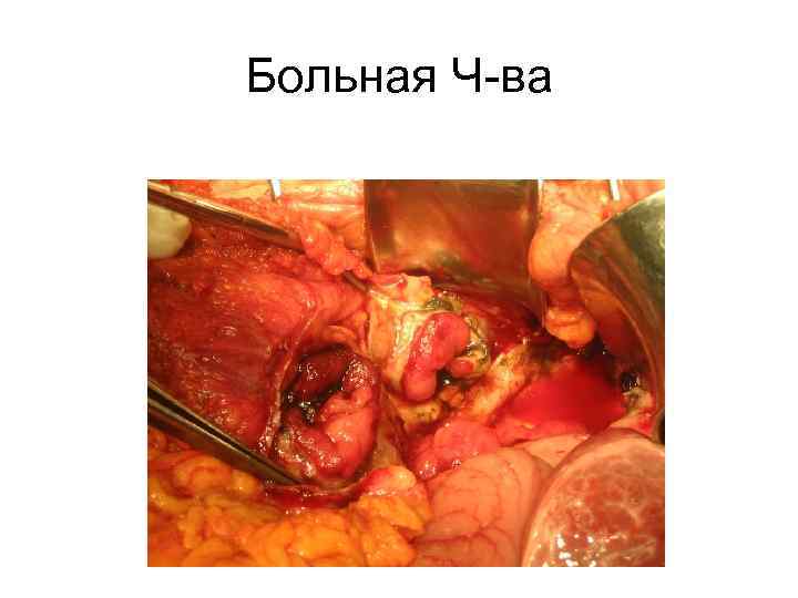 Больная Ч-ва 