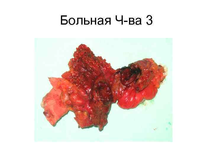 Больная Ч-ва 3 