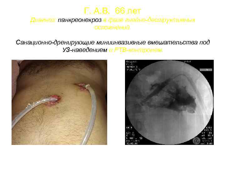 Г. А. В. 66 лет Диагноз: панкреонекроз в фазе гнойно-деструктивных осложнений. Санационно-дренирующие миниинвазивные вмешательства