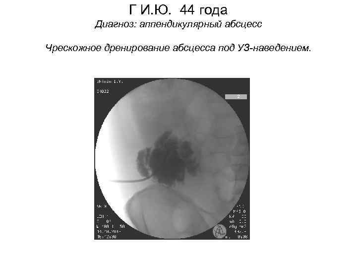 Г И. Ю. 44 года Диагноз: аппендикулярный абсцесс Чрескожное дренирование абсцесса под УЗ-наведением. 