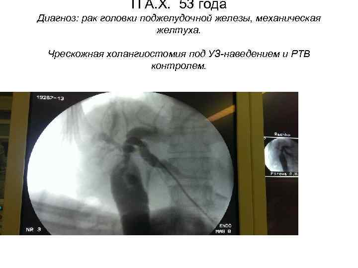 П А. Х. 53 года Диагноз: рак головки поджелудочной железы, механическая желтуха. Чрескожная холангиостомия