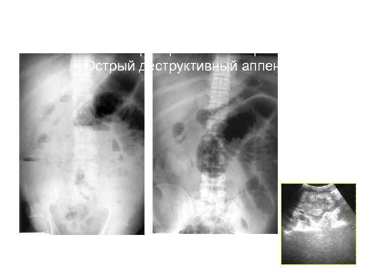 Распространенный перитонит Острый деструктивный аппендицит 