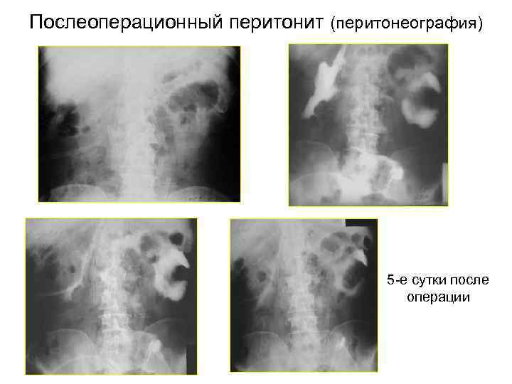 Послеоперационный перитонит (перитонеография) 5 -е сутки после операции 
