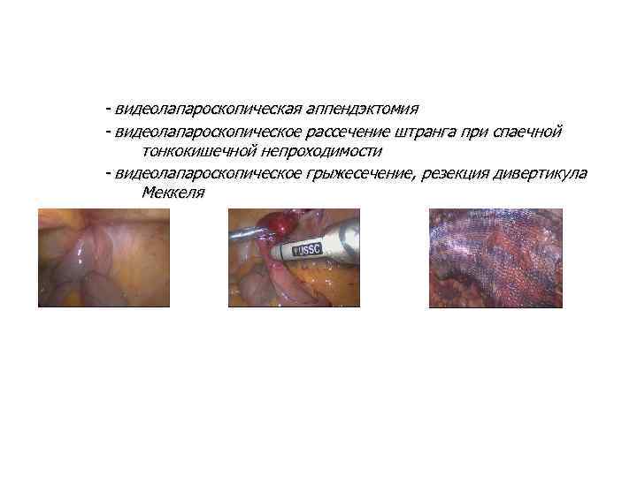 - видеолапароскопическая аппендэктомия - видеолапароскопическое рассечение штранга при спаечной тонкокишечной непроходимости - видеолапароскопическое грыжесечение,