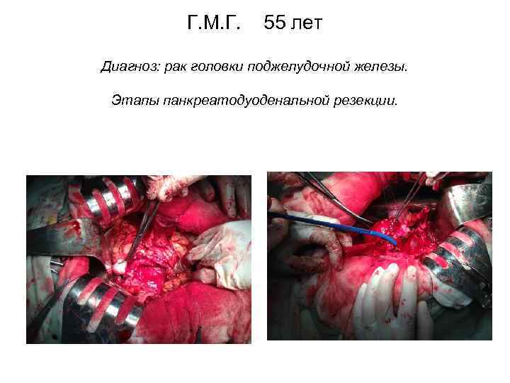 Г. М. Г. 55 лет Диагноз: рак головки поджелудочной железы. Этапы панкреатодуоденальной резекции. 