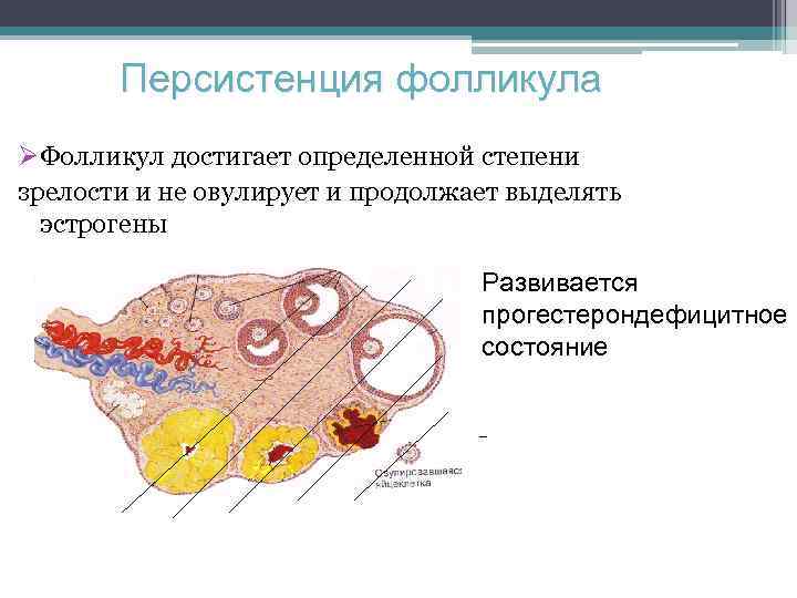 Персистенция фолликула ØФолликул достигает определенной степени зрелости и не овулирует и продолжает выделять эстрогены