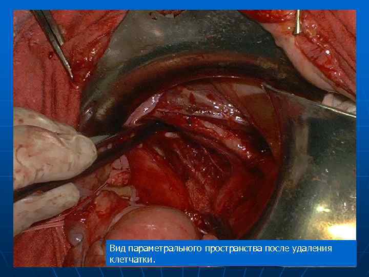 Вид параметрального пространства после удаления клетчатки. 
