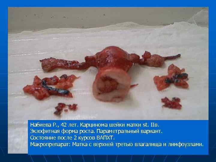 Набиева Р. , 42 лет. Карцинома шейки матки st. IIв. Экзофитная форма роста. Параметральный