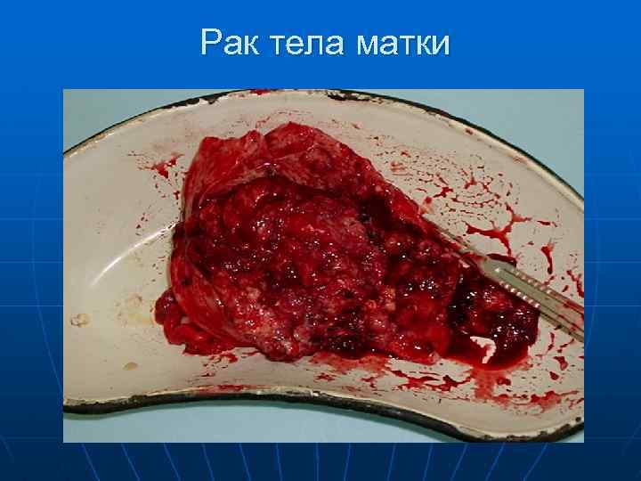 Рак тела матки 