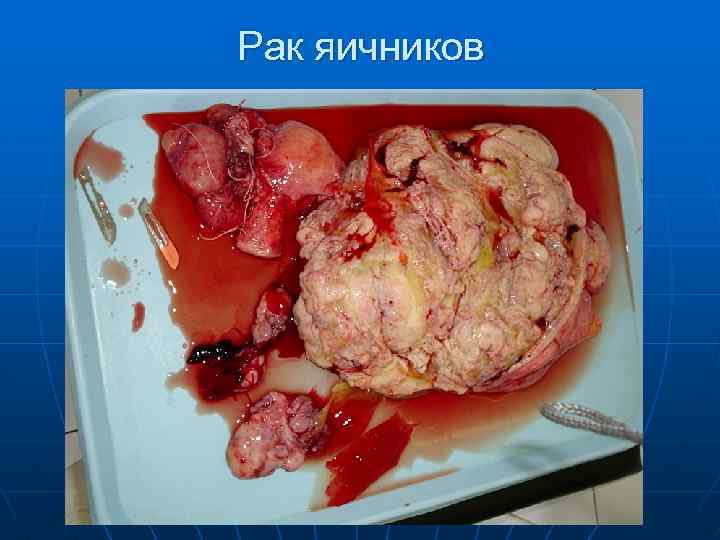 Рак яичников 