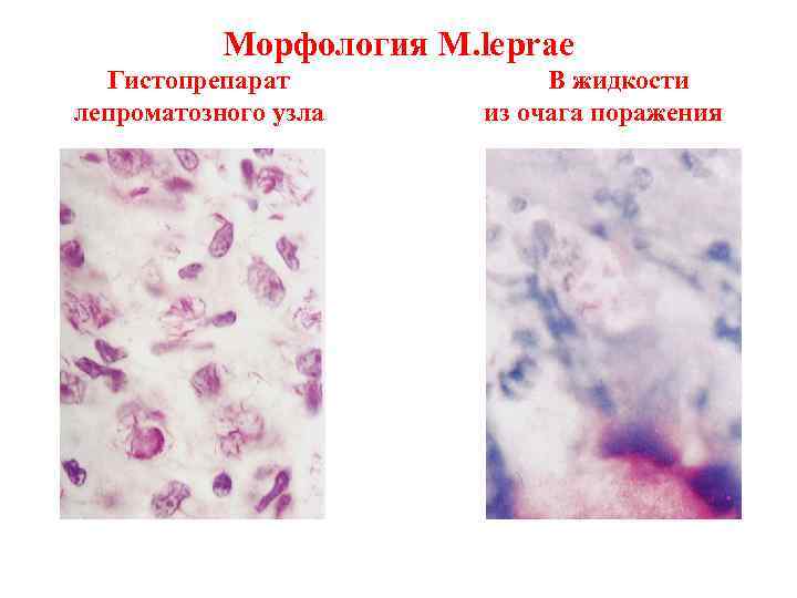 Патогенные микобактерии. Возбудитель туберкулеза микробиология. Микобактерии туберкулеза микробиология. Микобактерии туберкулеза под микроскопом. Mycobacterium tuberculosis микробиология.