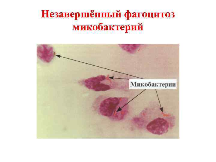 Незавершённый фагоцитоз микобактерий 