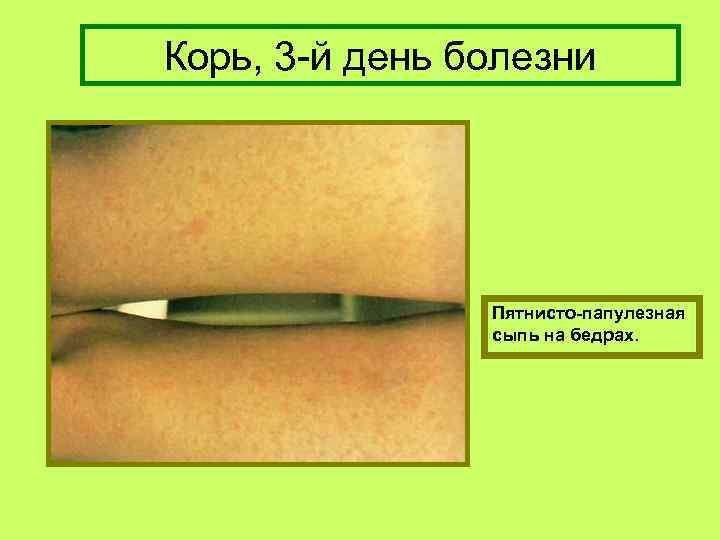 Корь, 3 -й день болезни Пятнисто-папулезная сыпь на бедрах. 