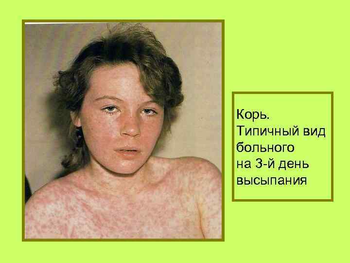 Корь. Типичный вид больного на 3 -й день высыпания 