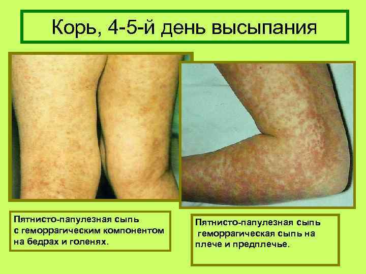 Корь, 4 -5 -й день высыпания Пятнисто-папулезная сыпь с геморрагическим компонентом на бедрах и