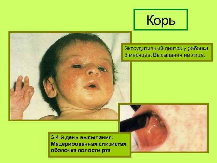 Корь Экссудативный диатез у ребенка 3 месяцев. Высыпания на лице. 3 -4 -й день