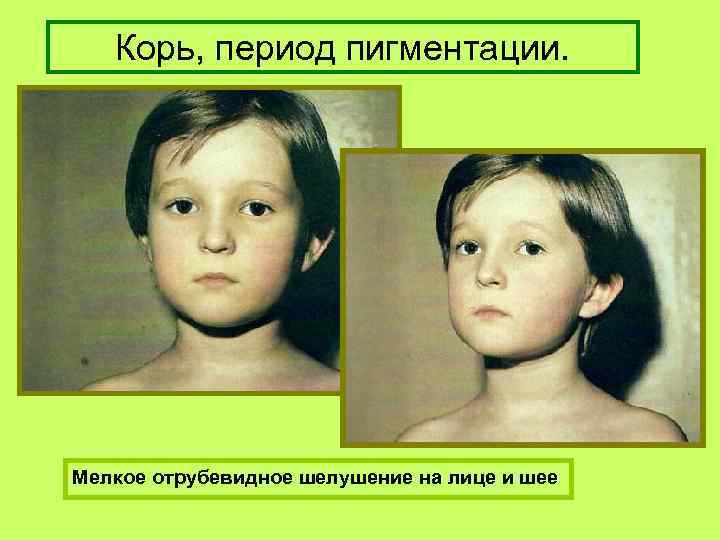 Корь, период пигментации. Мелкое отрубевидное шелушение на лице и шее 