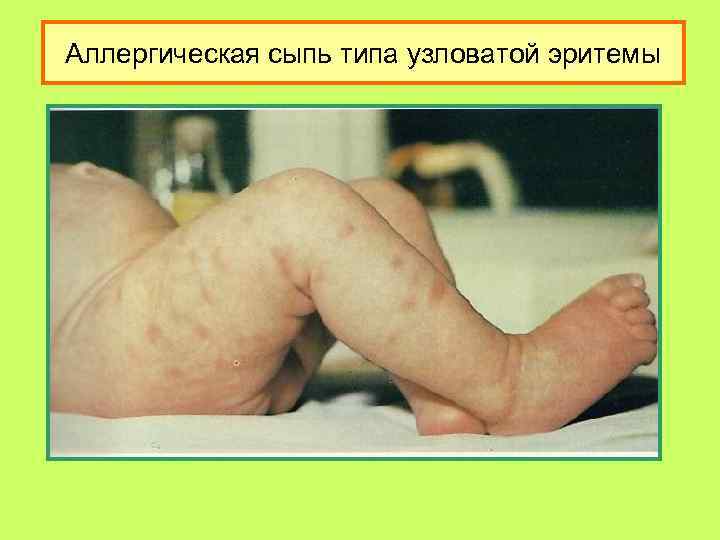 Аллергическая сыпь типа узловатой эритемы 