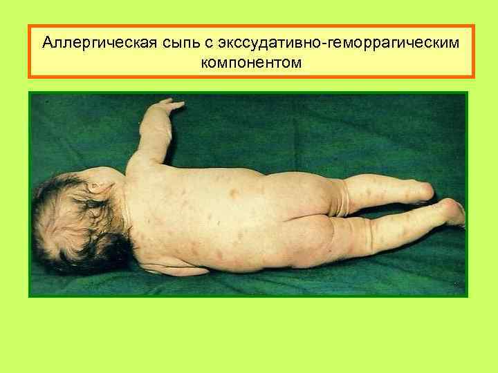 Аллергическая сыпь с экссудативно-геморрагическим компонентом 