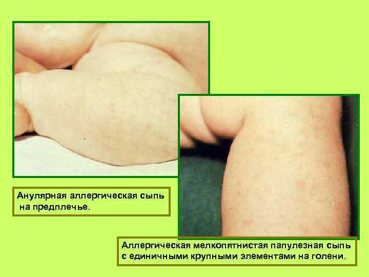 Анулярная аллергическая сыпь на предплечье. Аллергическая мелкопятнистая папулезная сыпь с единичными крупными элементами на